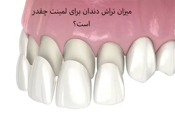 چه مقدار از تراش دندان برای لمینت لازم است؟ 