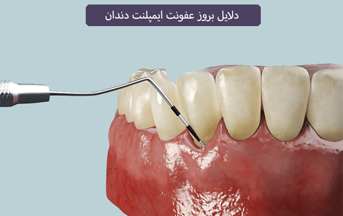 دلایل بروز عفونت ایمپلنت دندان