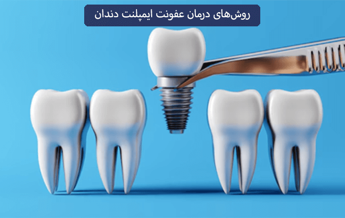روشهای درمان عفونت ایمپلنت دندان