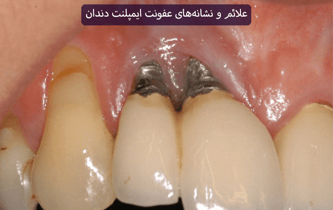 علائم و نشانههای عفونت ایمپلنت دندان