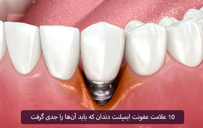 ۱۰ علامت عفونت ایمپلنت دندان که باید آن‌ها را جدی گرفت