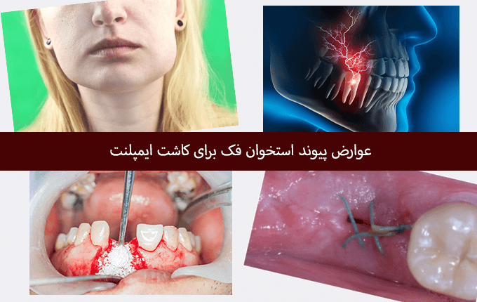 عوارض پودر استخوان در ایمپلنت