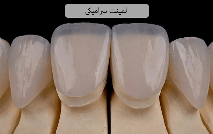 لمینت سرامیکی