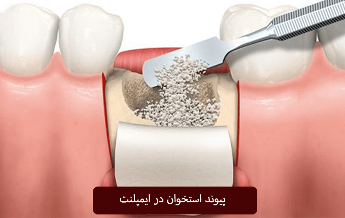 پیوند استخوان در ایمپلنت