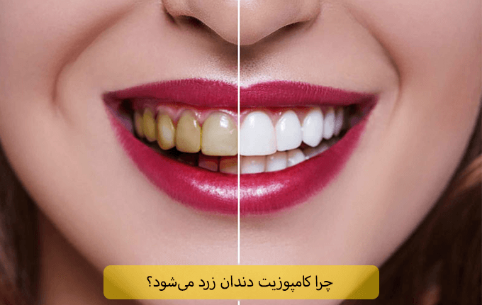 چرا کامپوزیت دندان زرد می‌شود؟