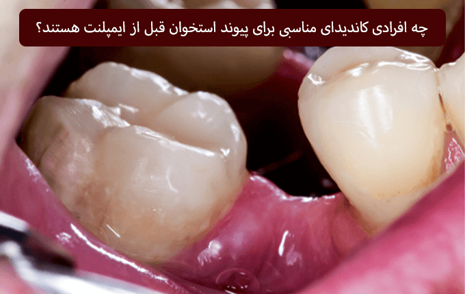 چه افرادی کاندیدای مناسبی برای پیوند استخوان قبل از ایمپلنت هستند؟