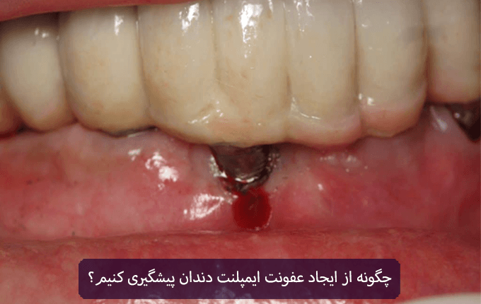 چگونه از ایجاد عفونت ایمپلنت دندان پیشگیری کنیم؟