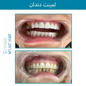 نمونه درمان خانه ایمپلنت
