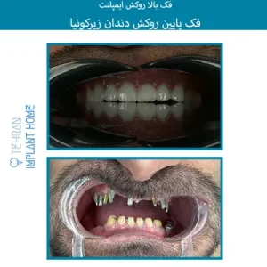 نمونه درمان خانه ایمپلنت