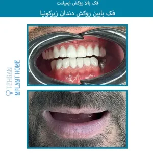 نمونه درمان خانه ایمپلنت