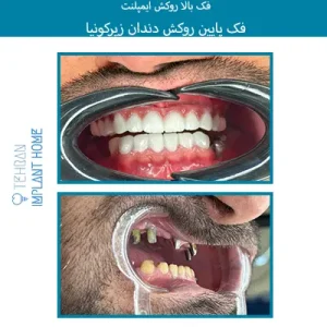 نمونه درمان خانه ایمپلنت