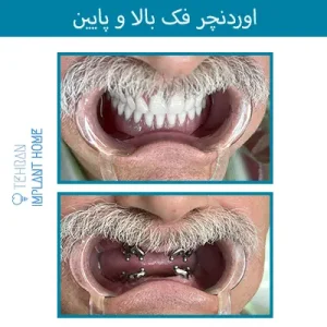 نمونه درمان خانه ایمپلنت