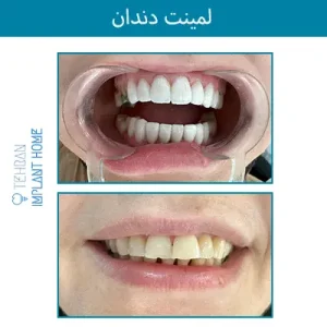 نمونه درمان خانه ایمپلنت