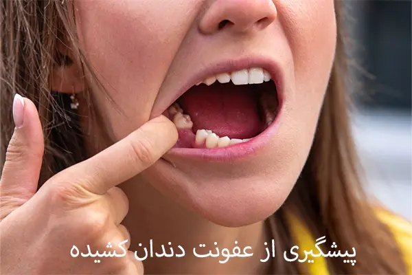 چطور می‌توان از عفونت بعد از کشیدن دندان پیشگیری کرد؟