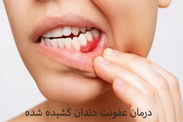 درمان عفونت دندان کشیده شده