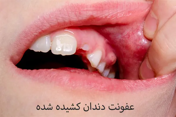 چگونه عفونت دندان کشیده شده را درمان کنیم؟