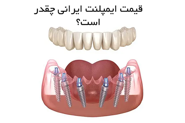 قیمت ایمپلنت ایرانی چقدر است؟