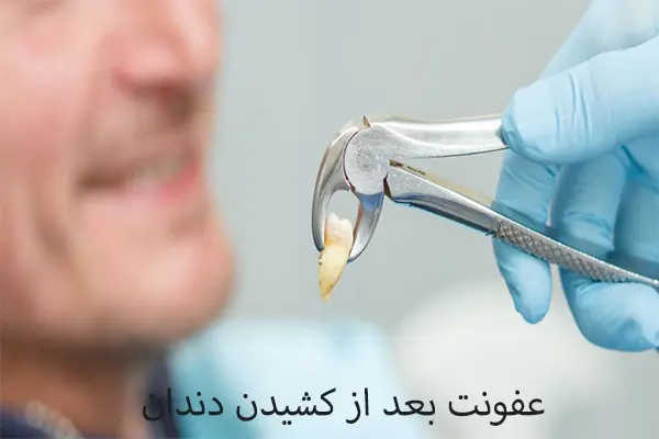 علل بروز عفونت پس از کشیدن دندان
