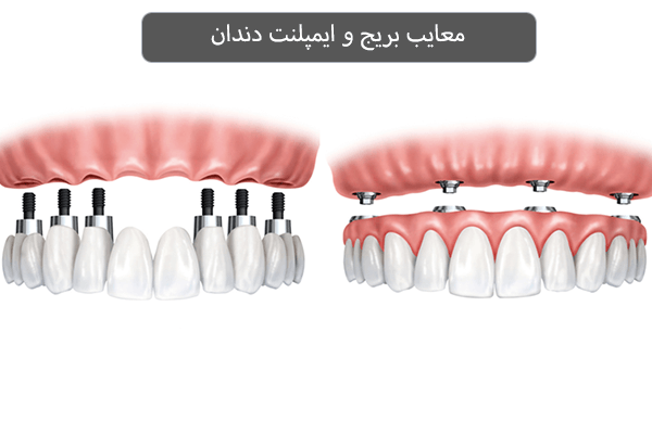 معایب بریج و ایمپلنت دندان