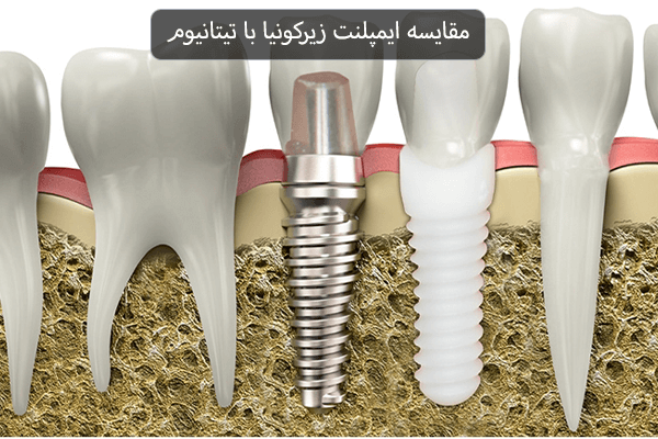مقایسه ایمپلنت زیرکونیا با تیتانیوم