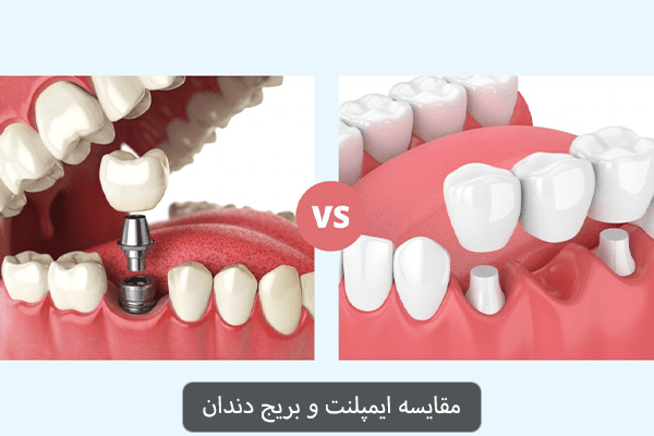 مقایسه ایمپلنت و بریج دندان