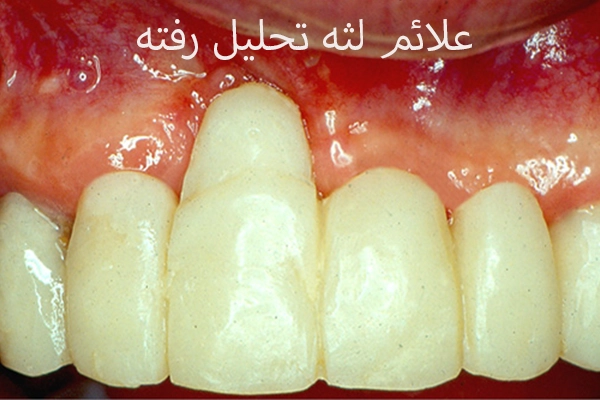 از کجا بفهمیم لثه تحلیل رفته؟