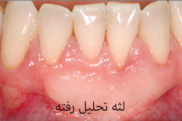 از کجا بفهمیم لثه تحلیل رفته؟