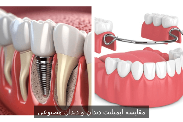 مقایسه ایمپلنت دندان و دندان مصنوعی