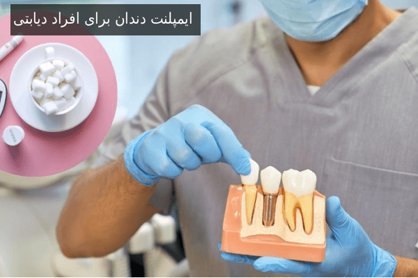 ایمپلنت دندان برای افراد دیابتی