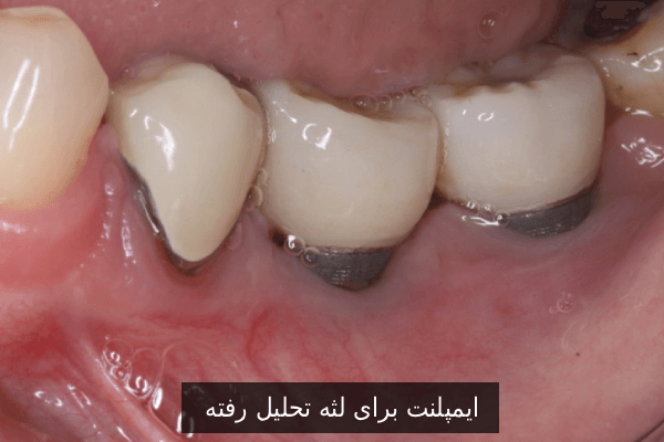 ایمپلنت برای لثه تحلیل رفته