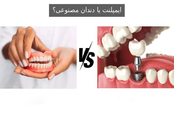 ایمپلنت یا دندان مصنوعی؟