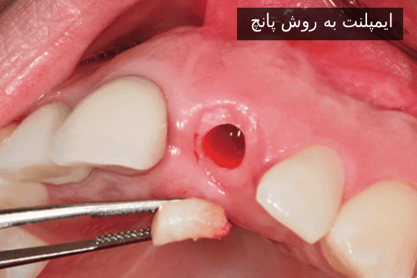 ایمپلنت به روش پانچ