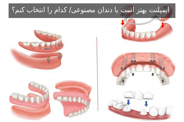 ایمپلنت بهتر است یا دندان مصنوعی/ کدام را انتخاب کنم؟