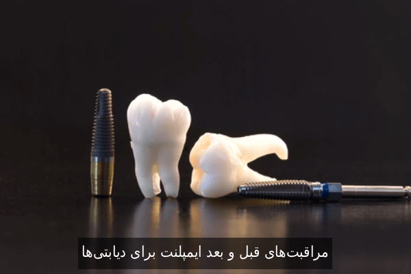 مراقبت‌های قبل و بعد ایمپلنت برای دیابتی‌ها