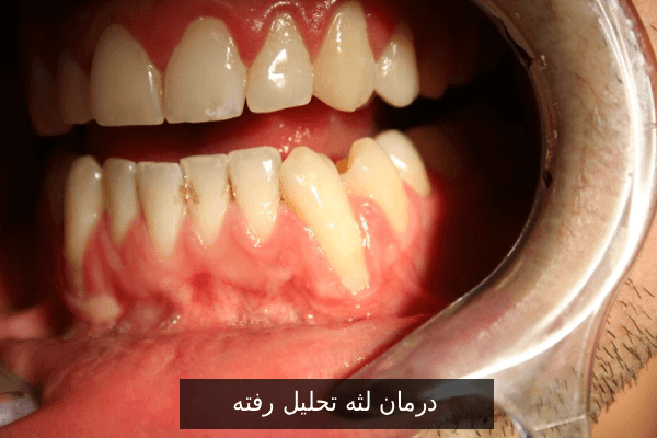 درمان لثه تحلیل رفته