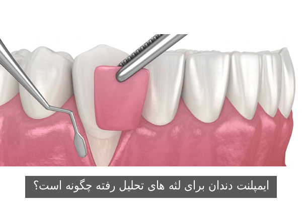 ایمپلنت دندان برای لثه های تحلیل رفته چگونه است؟