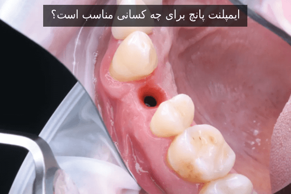 ایمپلنت پانچ برای چه کسانی مناسب است؟