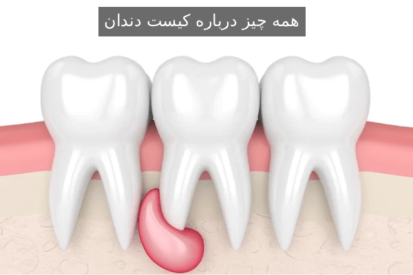 همه چیز درباره کیست دندان