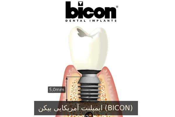 ایمپلنت آمریکایی بیکن (BICON)