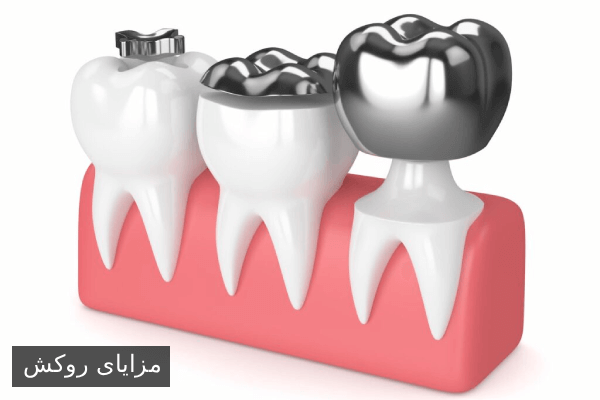 مزایای روکش