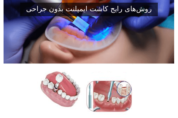 روش‌های رایج کاشت ایمپلنت بدون جراحی