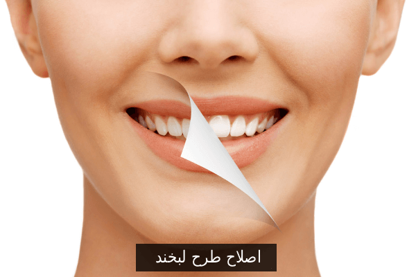اصلاح طرح لبخند