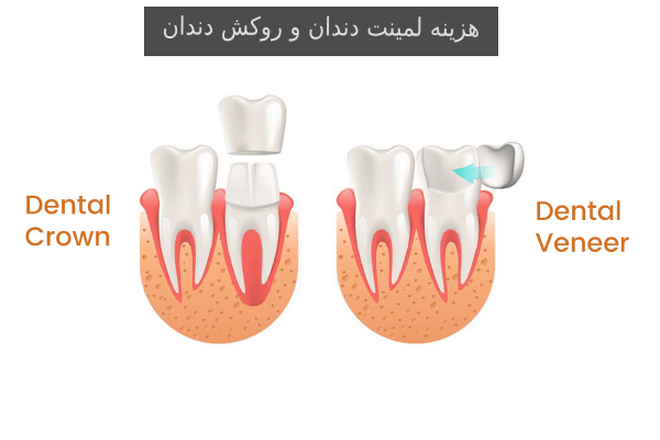 هزینه لمینت دندان و روکش دندان