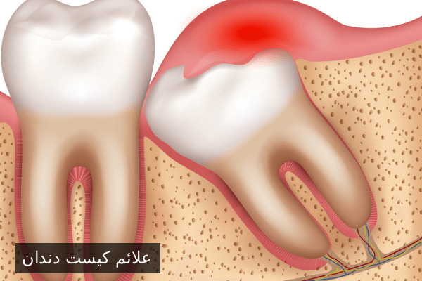 علائم کیست دندان