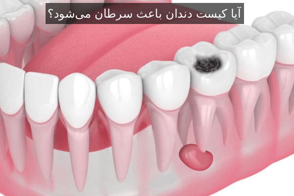 آیا کیست دندان باعث سرطان میشود؟