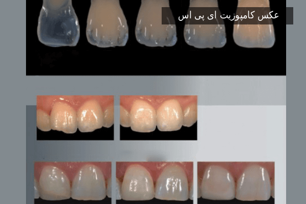 عکس کامپوزیت ای پی اس