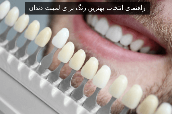 راهنمای انتخاب بهترین رنگ برای لمینت دندان 