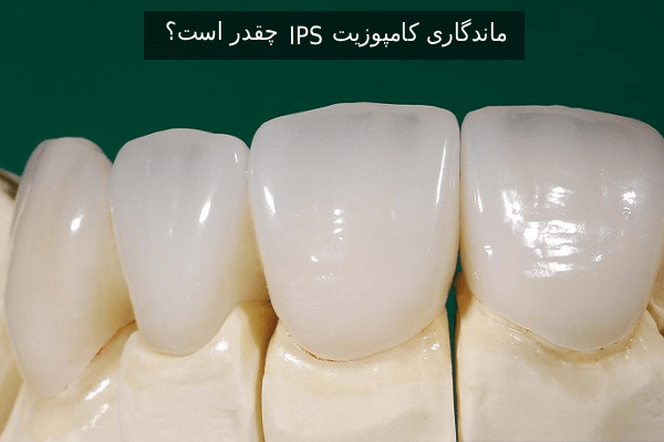 ماندگاری کامپوزیت IPS چقدر است؟