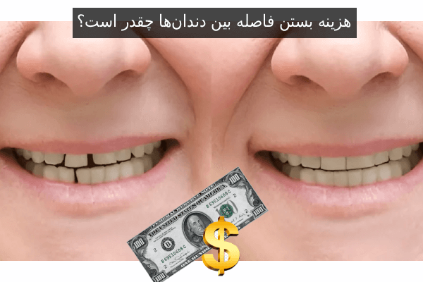 هزینه بستن فاصله بین دندانها چقدر است؟