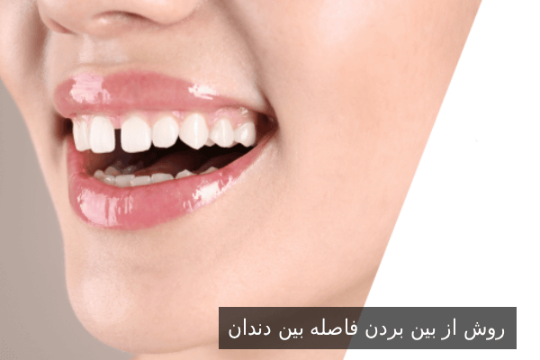 روش از بین بردن فاصله بین دندان